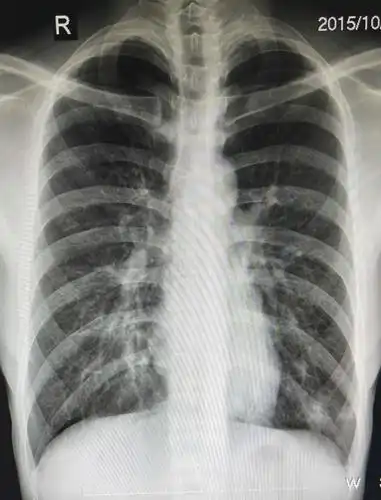 支气管肺炎的病因