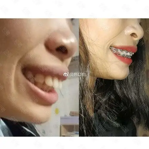 骨性龅牙牙齿矫正前后对比照