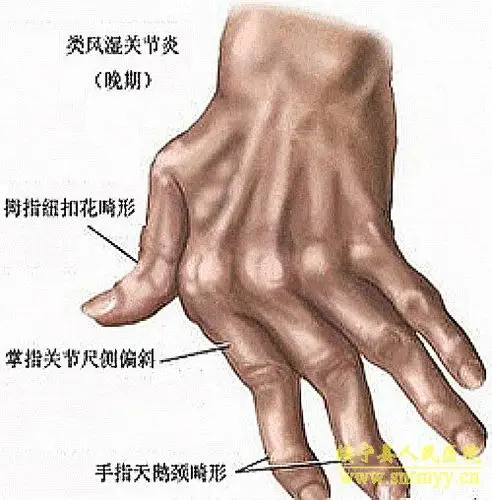 指节畸形:类风湿关节炎者,指关节可呈梭状畸形,活动受限,发作时红肿