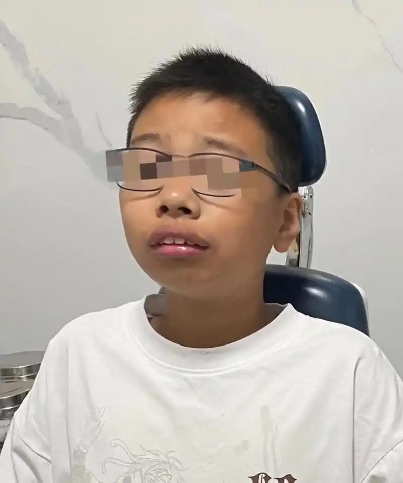 #爸妈很后悔-12岁儿子腺样体面容💔 【暑期学生就诊高峰期】 今天接