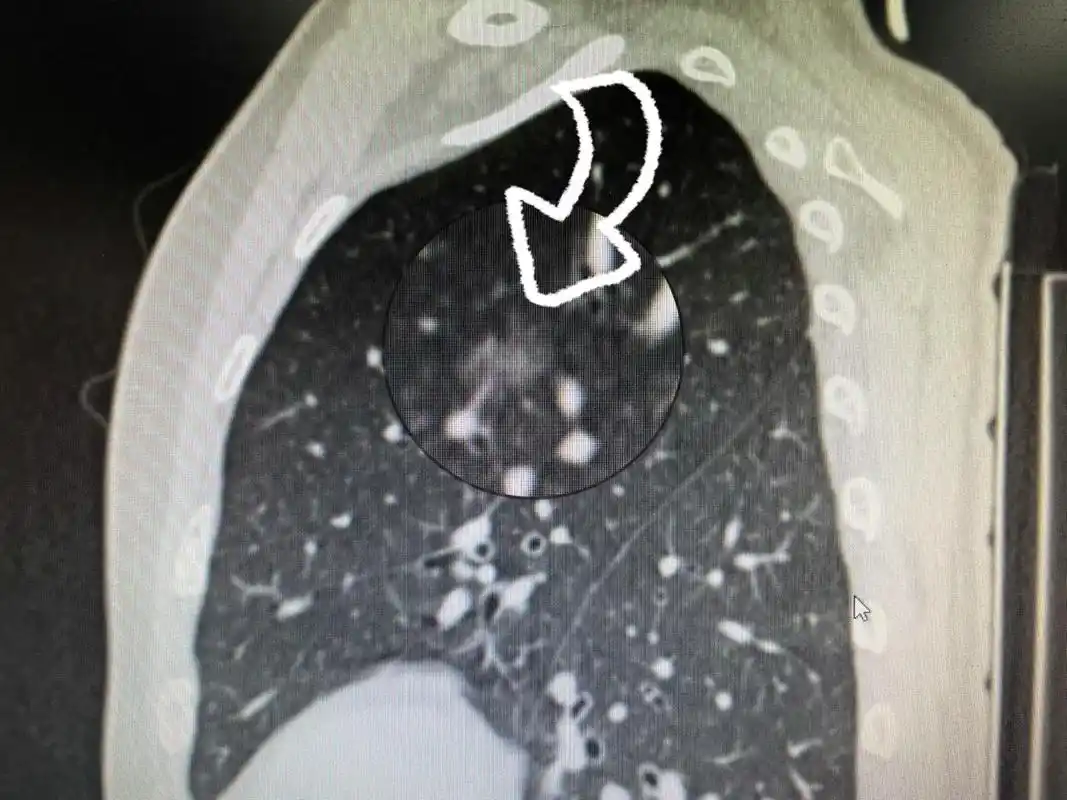 肺癌的诊断与治疗真不能千篇一律,也 - 抖音