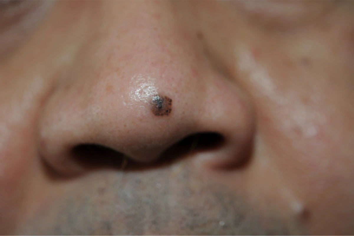 带你认识最常见的皮肤癌——基底细胞癌_基底细胞癌_症状_检查_治疗