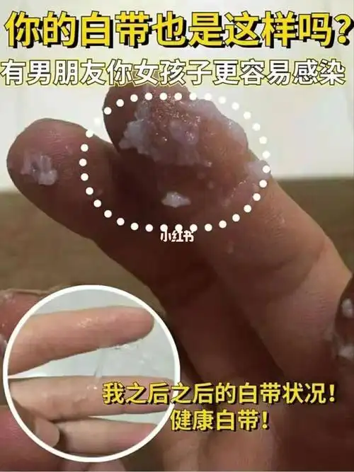 你的白带出现这种情况了吗