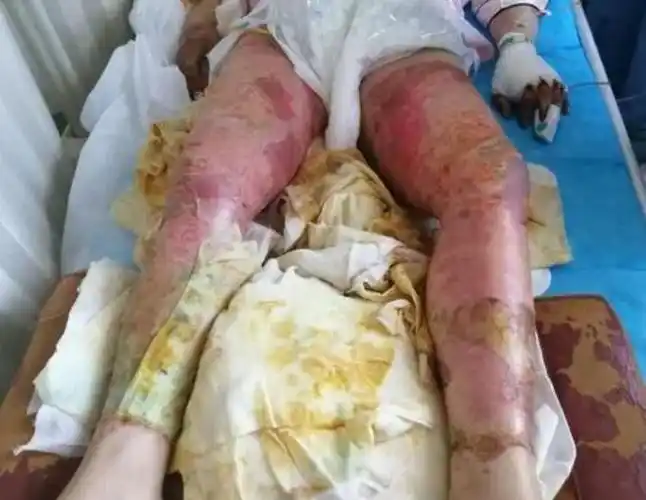 在医院病床上躺着一位重度烧伤的女子她全身都包满了纱布