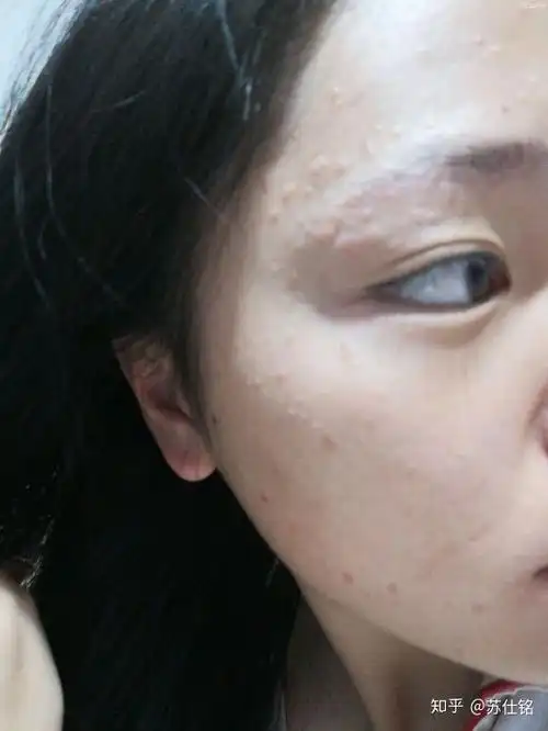 3年的扁平疣终于好了