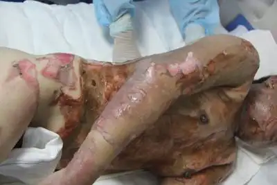 坚强单身妈妈被烧伤,跪求大家帮助,含泪叩谢