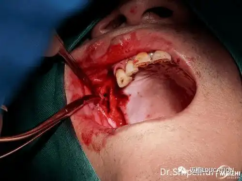 上颌窦粘膜修补术一例