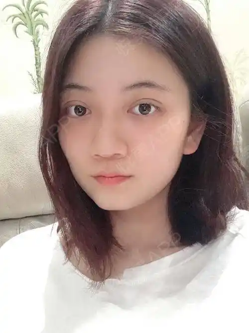 双眼皮的线条挺明显的,就是眼睛看上去有点肿,很期待越来越自然的样子