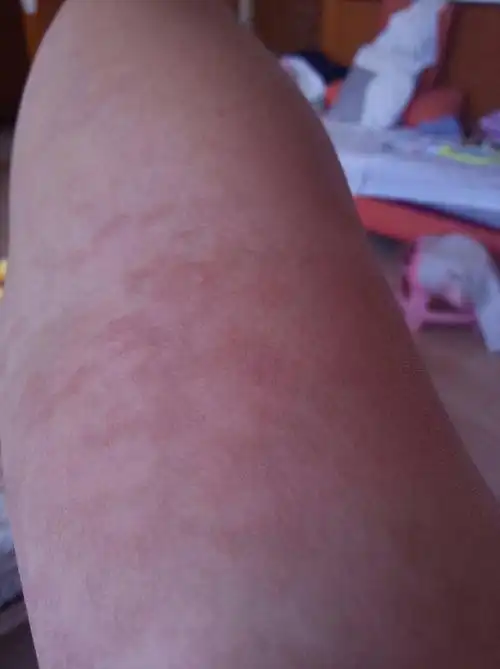 问:以前得过汗斑,以为胳膊上也长了汗斑.