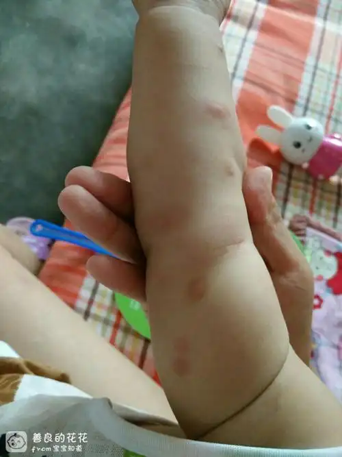 个胳膊上有好多这样的疙瘩,背上有三四个,宝妈们,帮我看看这是水痘吗?