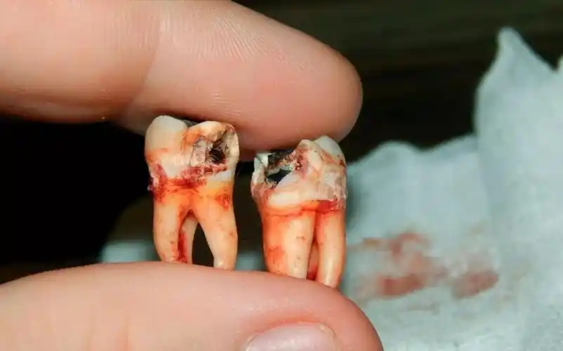 孕妇患者险失母子两命,仅仅是因为一颗牙齿……_智齿