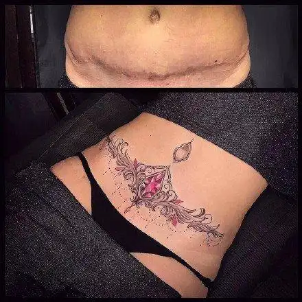 女生腹部掩盖伤疤纹身前后效果图