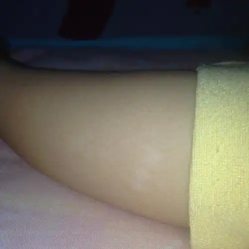 宝宝两岁了,腿上出现了这样的白斑,是咋回事啊?