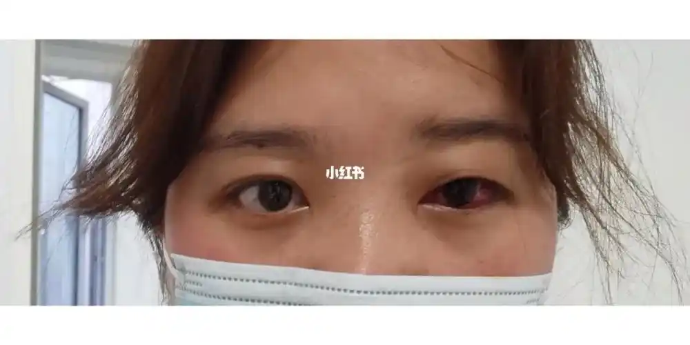 斜视手术后第一天