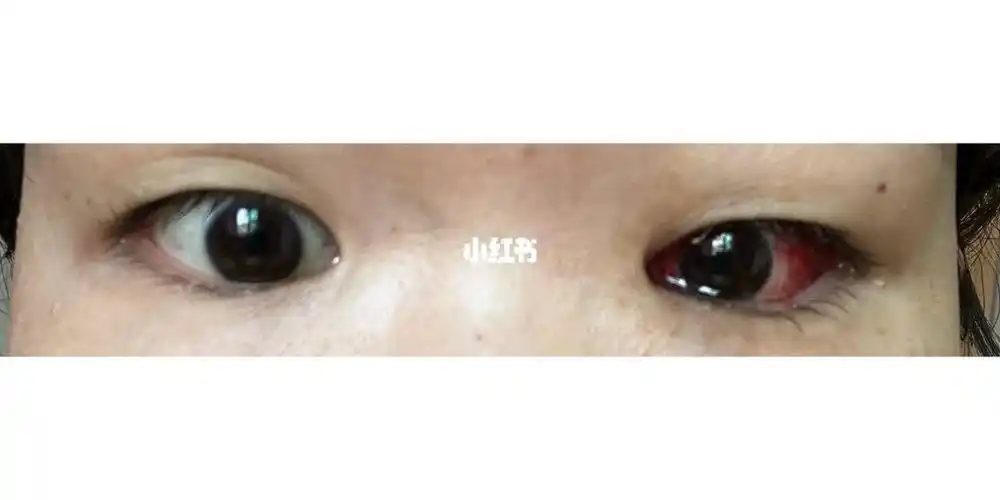 斜视手术第三天