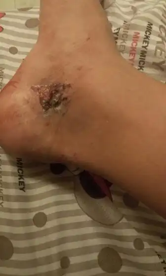 伤口有点严重 10 大家好我的脚被玻璃划伤了刚开始没怎么在意就撒了点