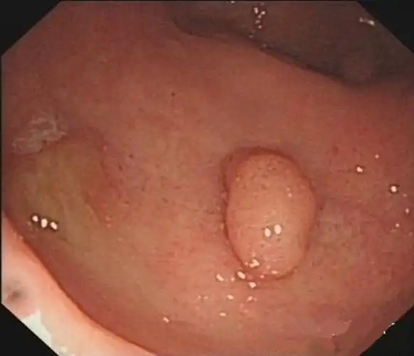 直肠息肉的早期症状图片_有来医生