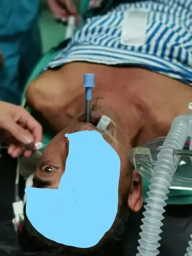 气道气管插管——云南省第三人民医院绿春医疗队麻醉新技术开展纪要