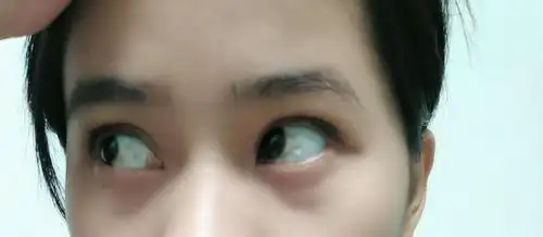 眼白很黄怎么办?