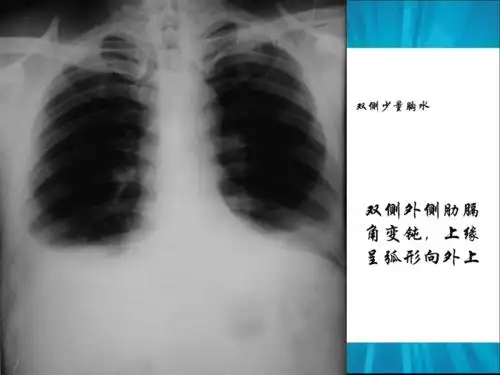 胸腔积液的影像诊断