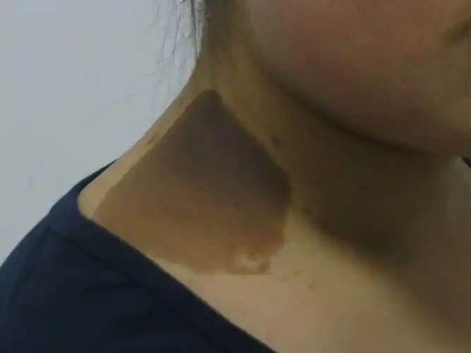 咖啡斑病理上一般表现为表皮的损害,基底层黑素细胞增加,色素合成增多