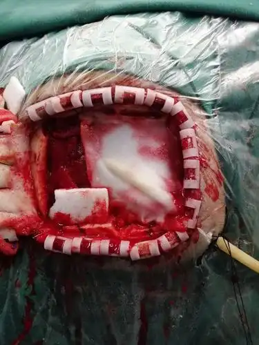 矢状窦旁脑功能区脑膜瘤切除术