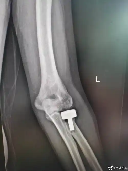 病例分享人工桡骨头置换一例