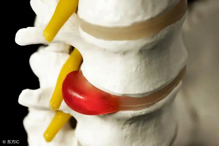 腰间盘膨出,突出,脱出有什么不同?骨科医生靠它来区分!