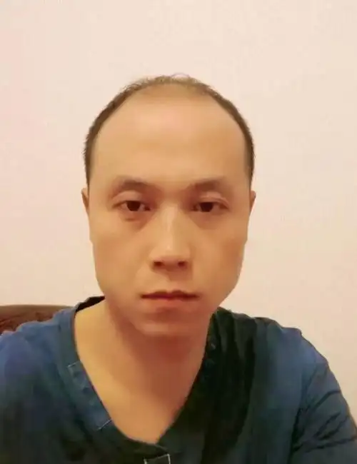 42岁秃顶大叔植发6小时逆转10年脱发长出真头发