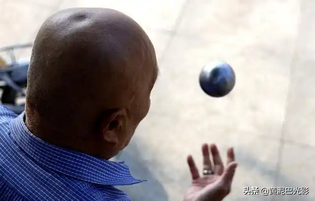 东北7旬大爷头顶13斤钢珠骑行练9年脑门上陷下大坑