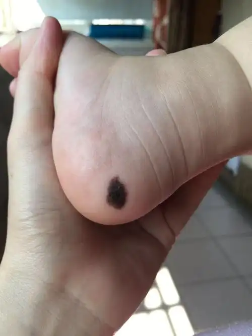 色素痣的注意事项 - 好大夫在线