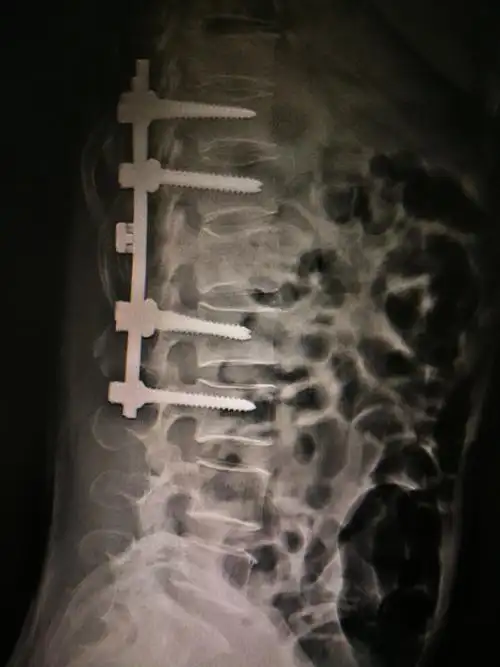 胸腰椎爆裂性骨折并不全瘫手术治疗 - 好大夫在线