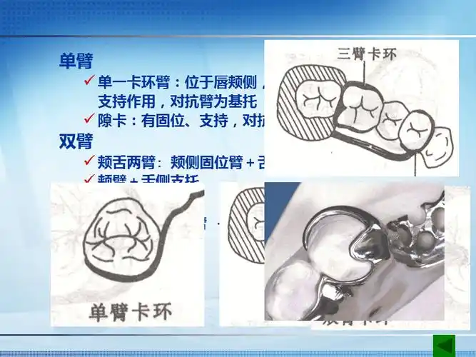 可摘局部义齿卡环的种类ppt课件