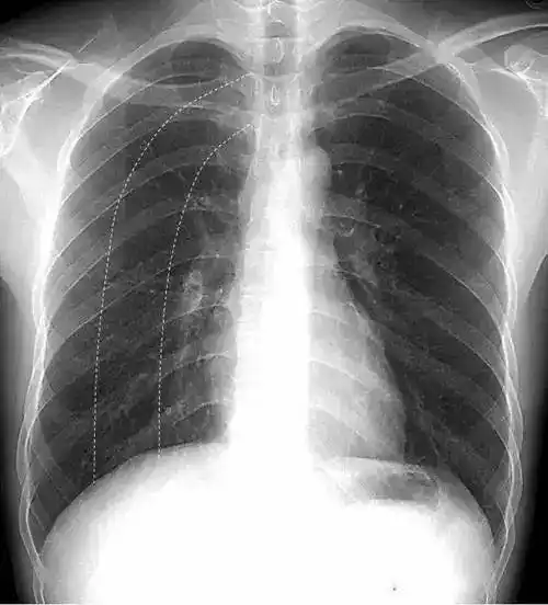 影像解剖入门正常胸片怎么看