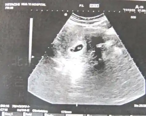 怀孕40天-45天孕囊多大?能做人流吗