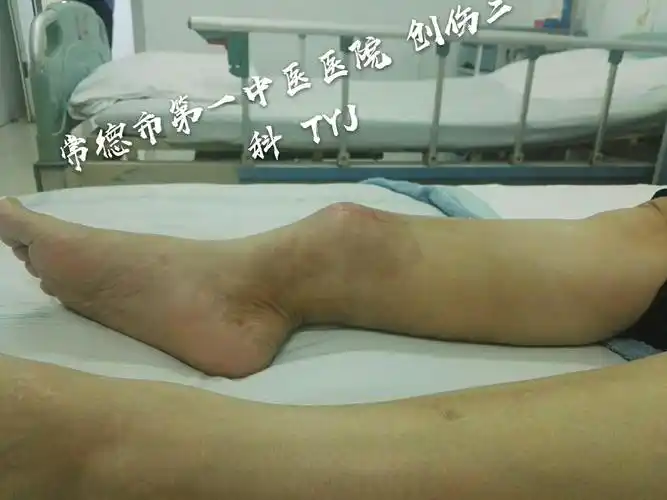 右侧胫腓骨陈旧性骨折(三个月)