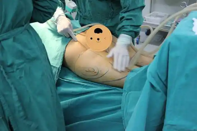 女网红因抽脂身亡生前拥有一副好皮囊最终却死于全身溃烂