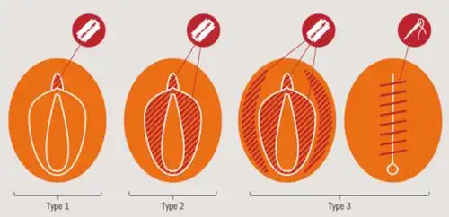 埃及于2008年禁止女性割礼,并于2016年将该行为定为重罪.
