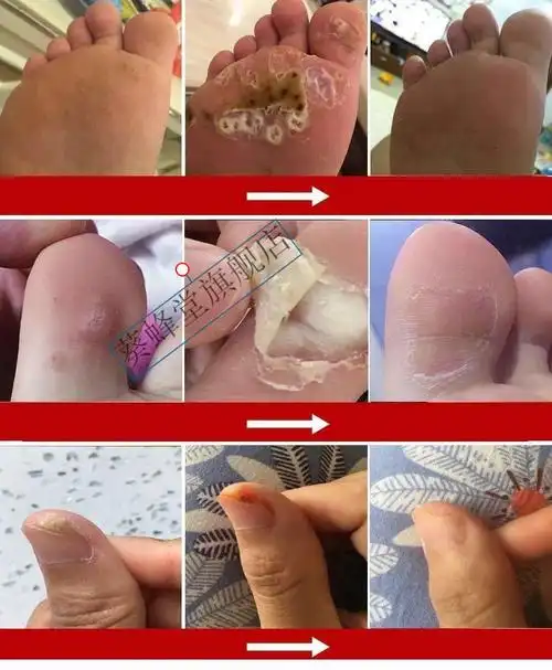 扁平i疣尖锐湿疣膏hpv五氟尿嘧啶软膏外用丝i状疣脖子颈部疣必治干扰