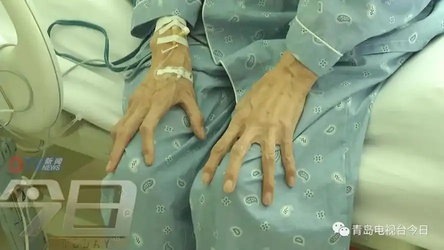 着同样体型特征的弟弟因发病被查出患有马凡氏综合征并进行了手术治疗