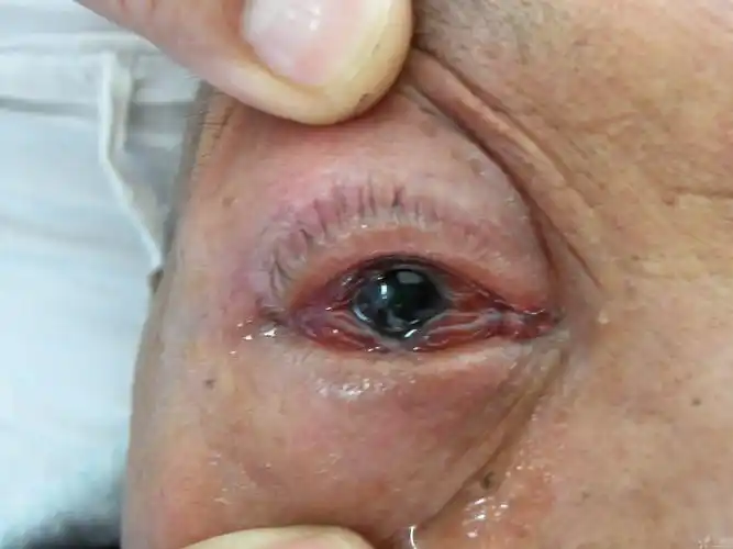 【眼表疾病讨论】球结膜高度水肿的原因 [病例帖]