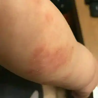 宝宝六个月,请问这是乾性湿疹吗?应如何护理