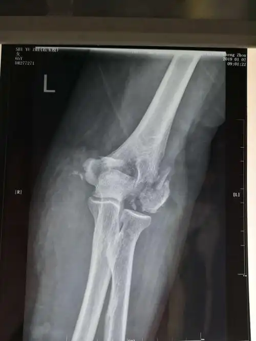hahn—steinthal骨折【郑州市骨科医院 微创骨科 杨通宝 燕冰】