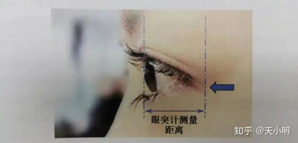 戴眼镜真的会让眼球突出像"金鱼眼"吗?