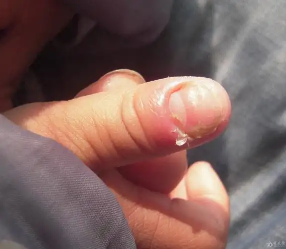 2岁半宝宝指甲周围红肿有皮肤脱屑指甲周边不规整