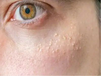 上海粟丘疹专家_上海治疗粟丘疹哪个专家好_上海治疗粟丘疹最好的专家