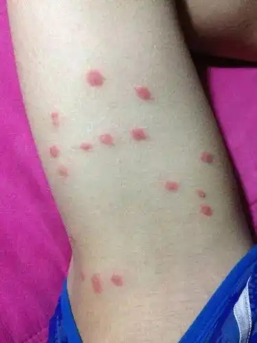 夏季不要忽视这5种小虫子的叮咬,有可能会危及生命_症状