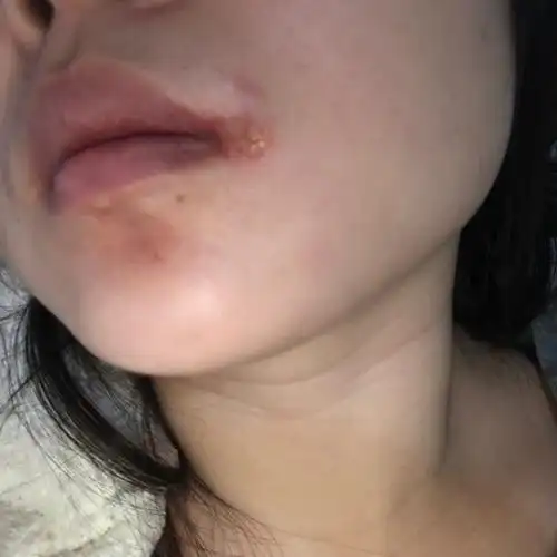 嘴角起泡是什么原因( 嘴角起泡是什么原因用什么药膏 )