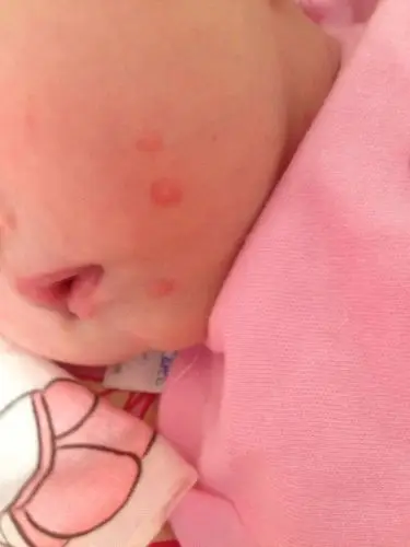 各位亲爱的网友,谁知道宝宝手上和脸上这些红疹子是怎么回事?起的?