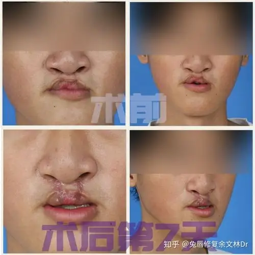 做完唇裂二期修复对比